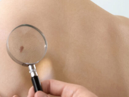 skin cancer who is at risk