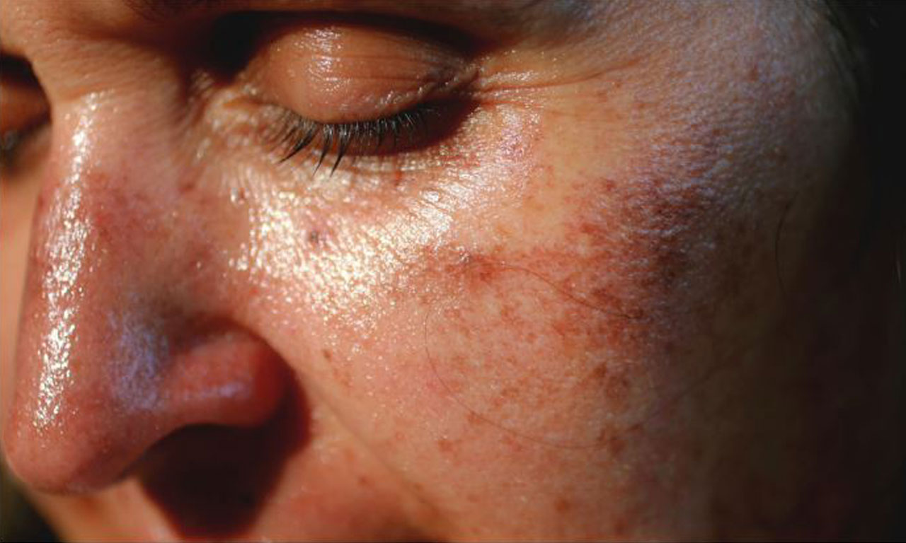 Treating Sun-Damaged Skin